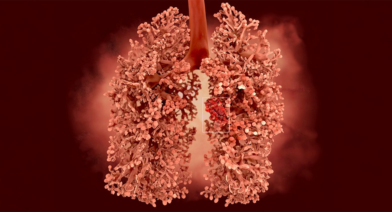 Lung with tumor animation