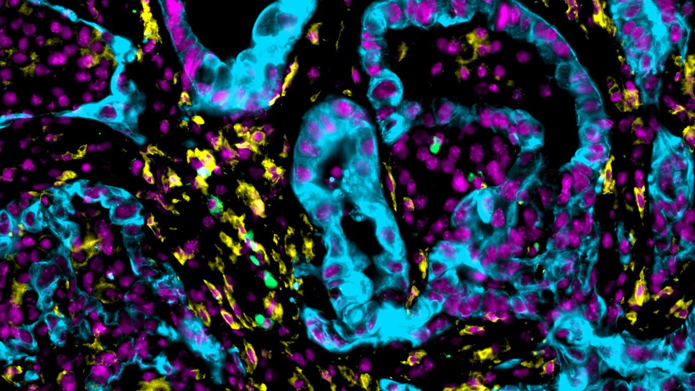 Pancreatic cancer cells (blue) surrounded by tumor-associated macrophages (yellow and green)