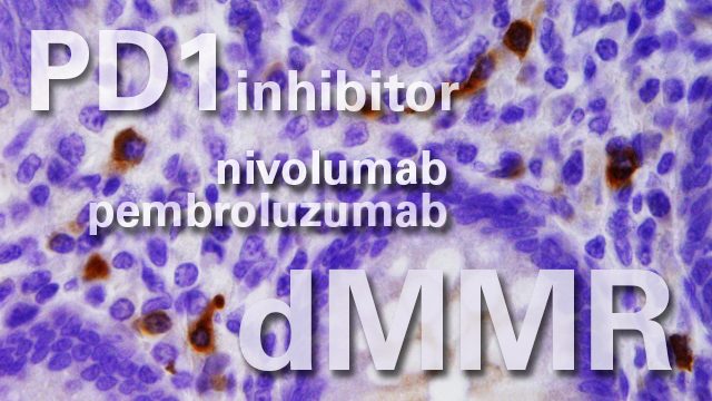 PD1 inhibitors help metastatic colorectal cancer patients