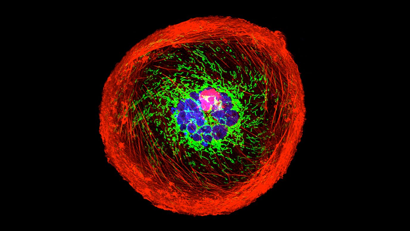 polyploid giant cancer cell (PGCC) from triple-negative breast cancer