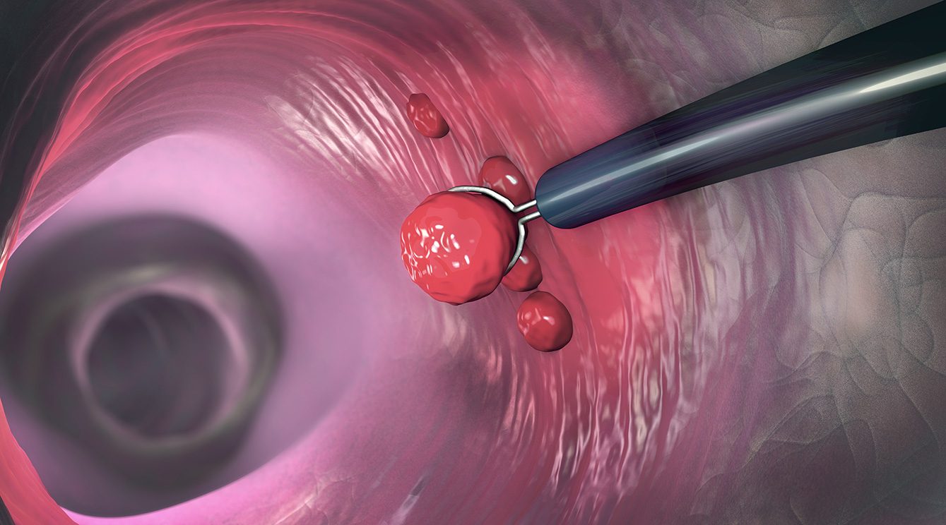 Close-up medical illustration of a lasso-shaped wire snare being used to remove a colon polyp inside the large intestine