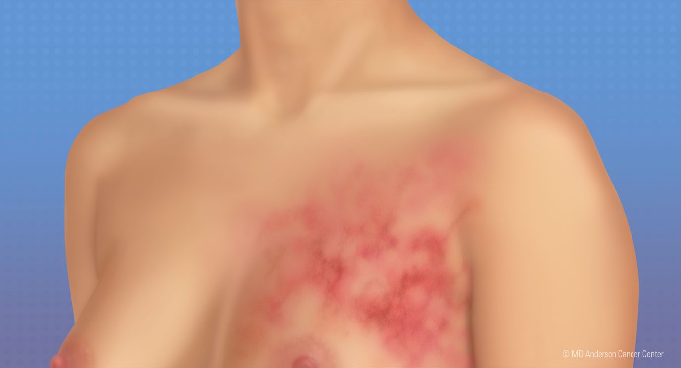 Medical illustration of inflammatory breast cancer rash on upper chest, breast of light-skinned woman against a blue background