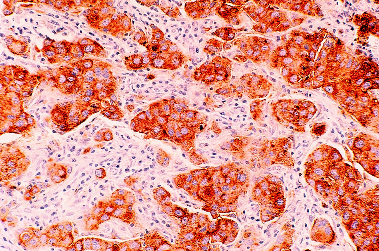 Microscopic view of invasive ductal carcinoma cells