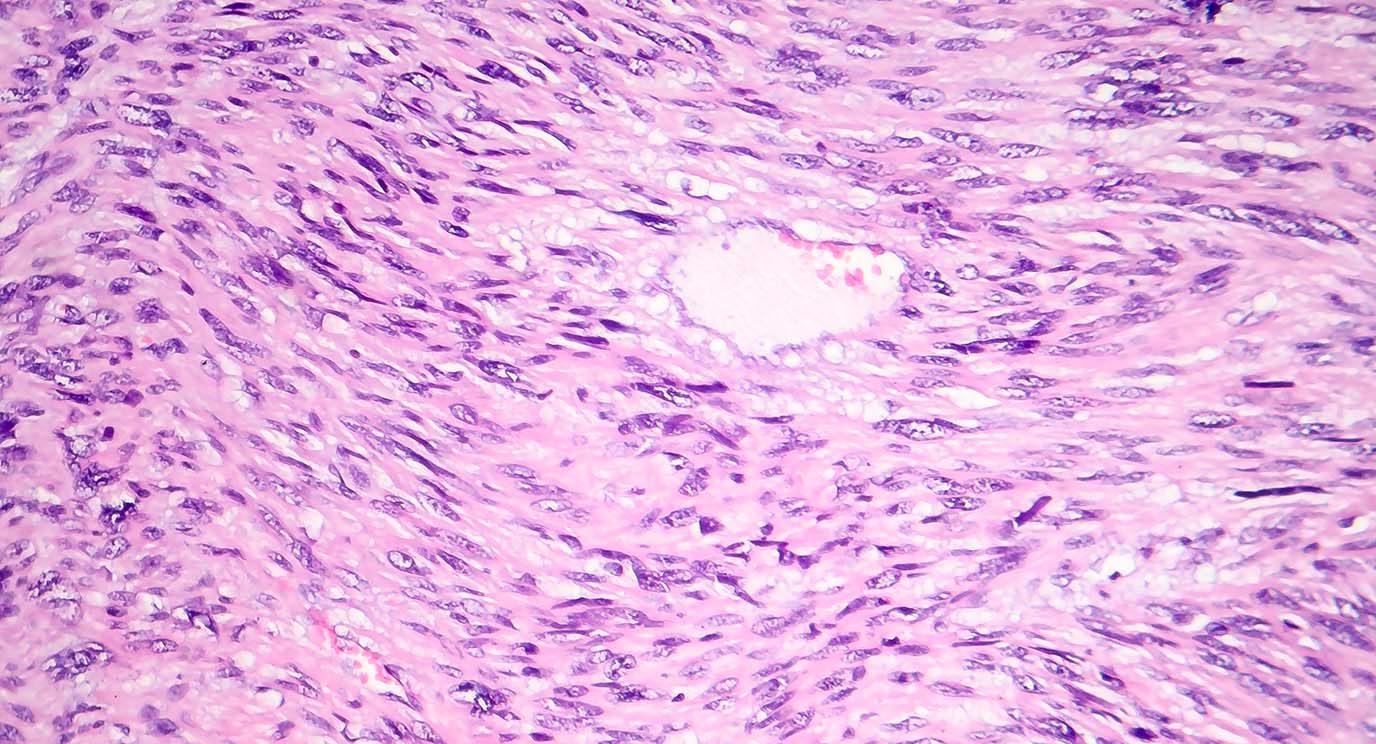 Leiomyosarcoma, a malignant cancerous smooth muscle tumor, light micrograph, photo under microscope