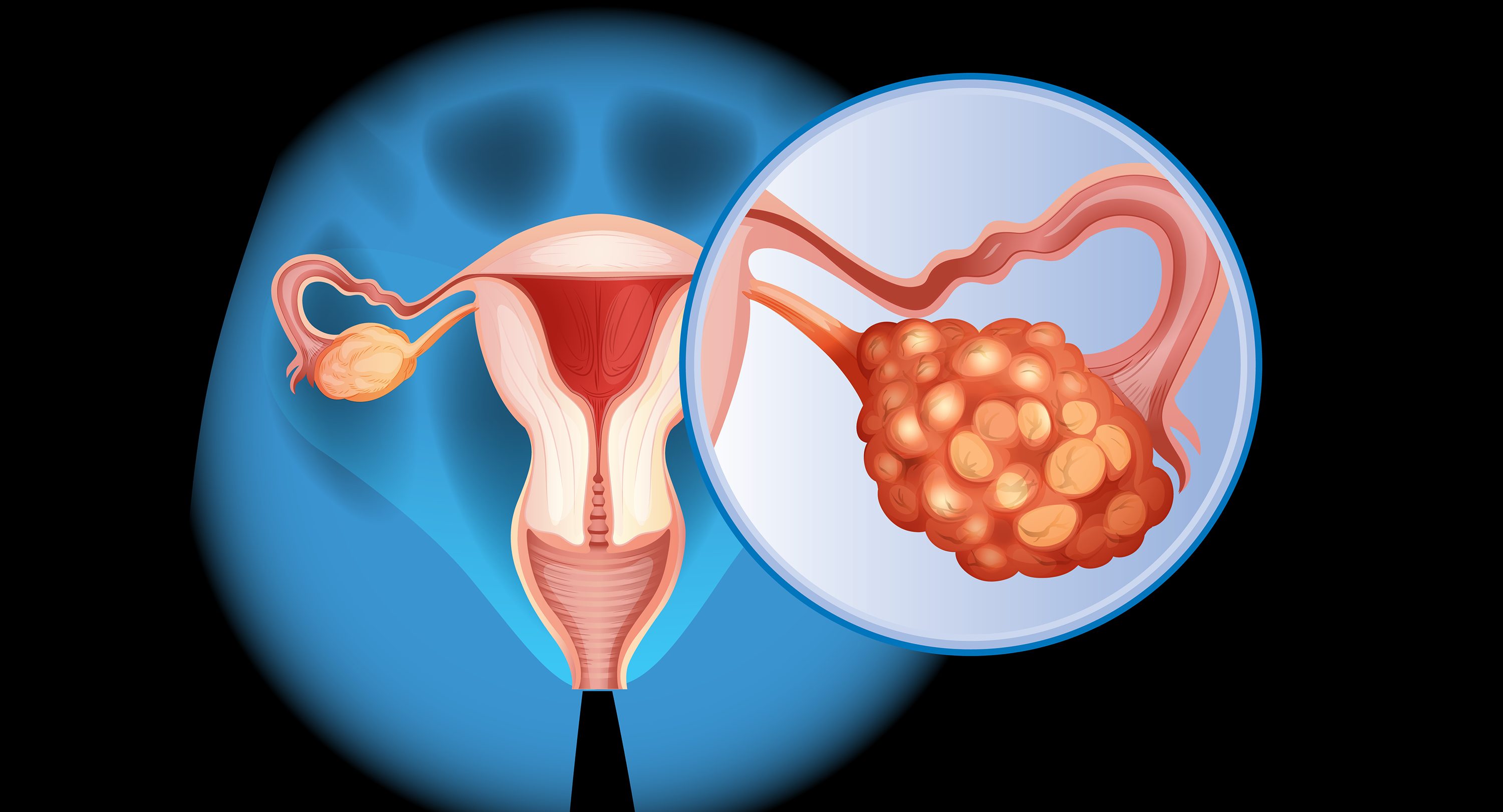 Illustration of a diagram showing ovarian cancer