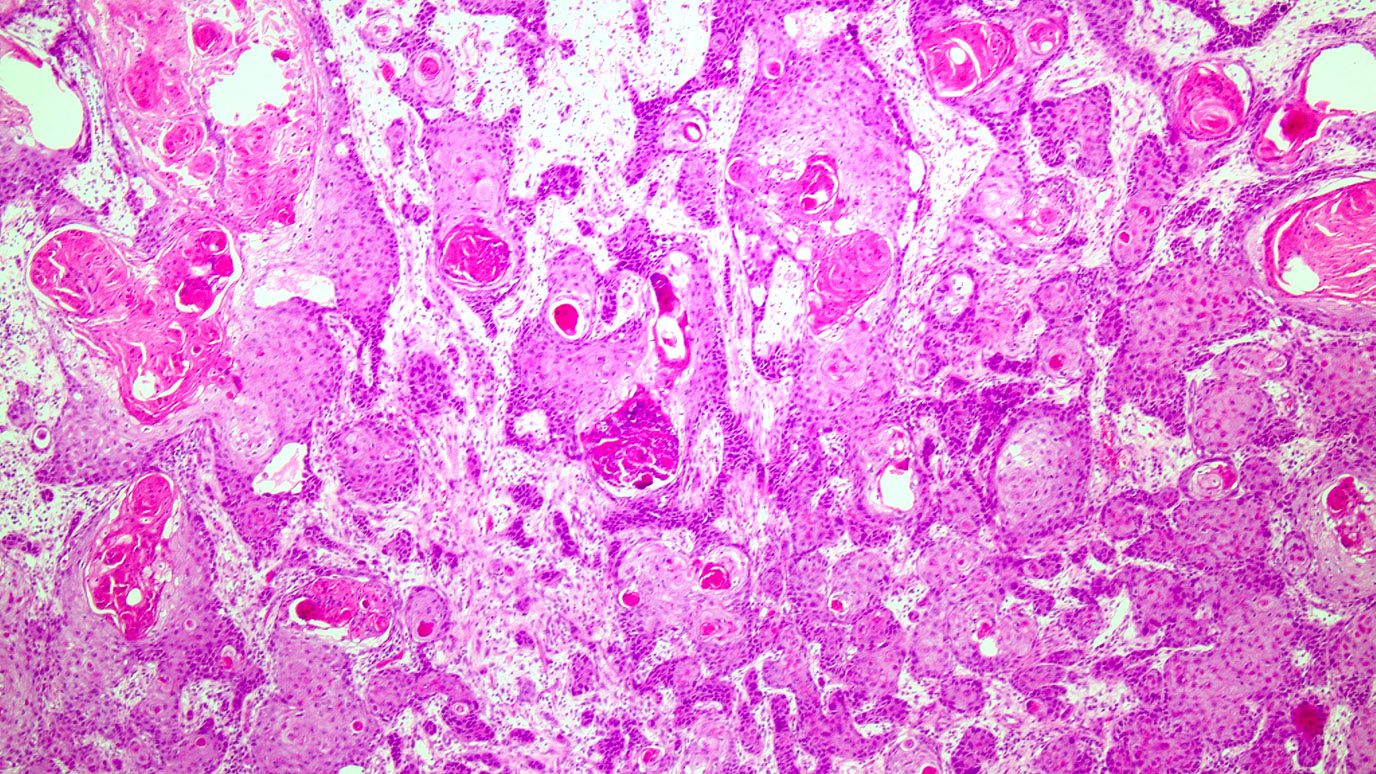Microscopic view of squamous cell carcinoma in shades of pink and white