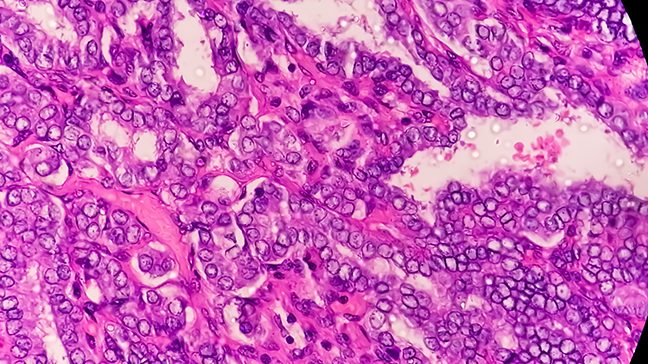 Microscopic view of papillary thyroid cancer cells tinted in shades of bright pink and purple for contrast