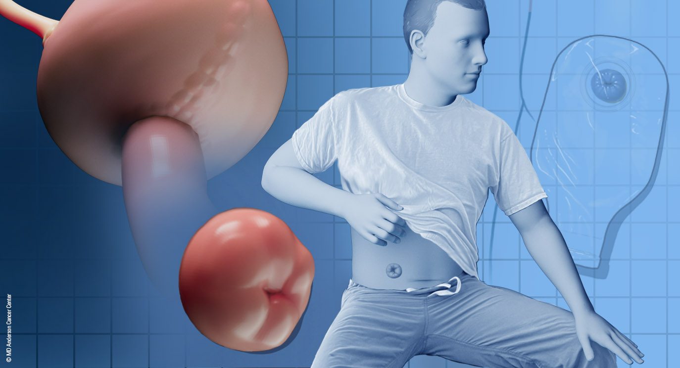 Illustration of a person with a urostomy, which is a surgical procedure that is used if the bladder is damaged or non-functional.