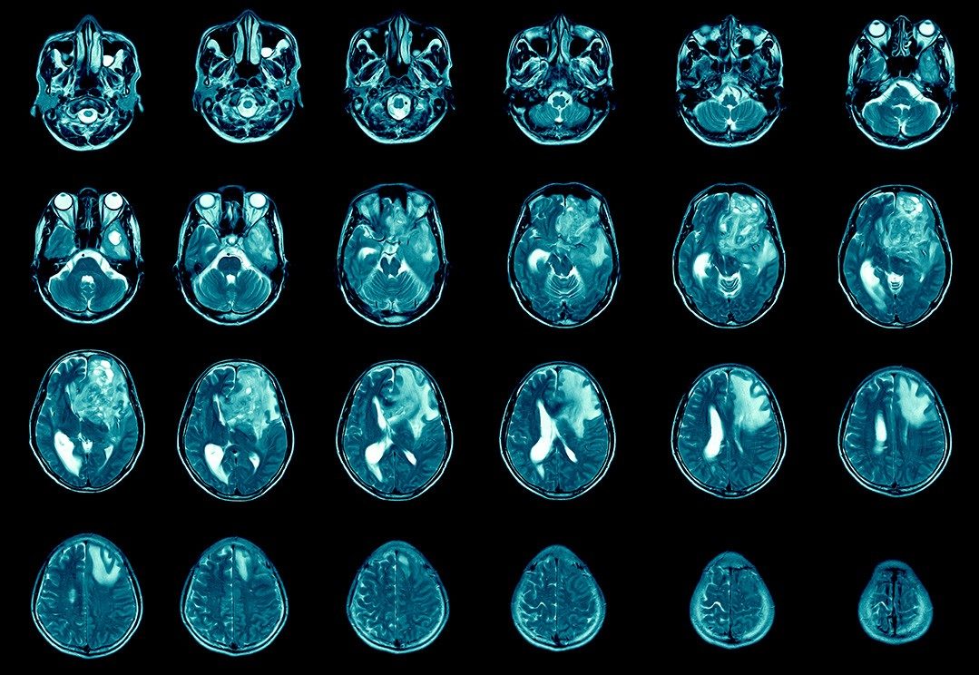 X-ray scans of glioblastoma growth