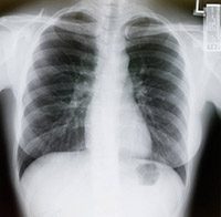 X-ray of lungs