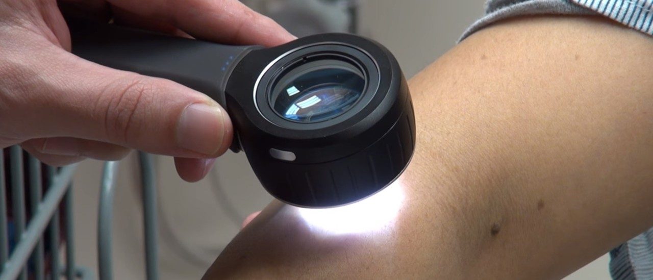 Cancerwise blog post: Skin cancer screening for skin cancer prevention