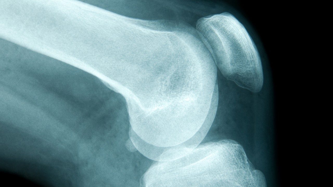 X-Ray of knee and leg bones