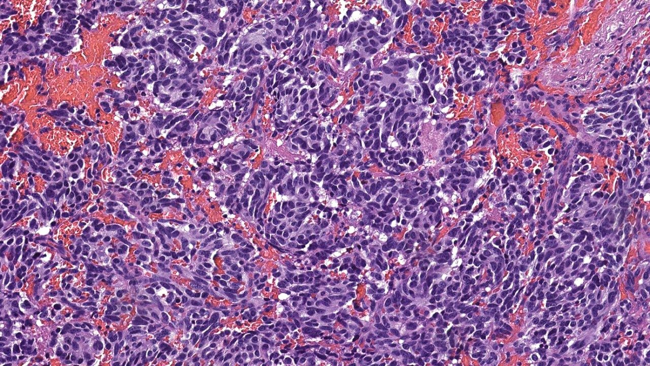 Neuroendocrine tumor cells seen under a microscope