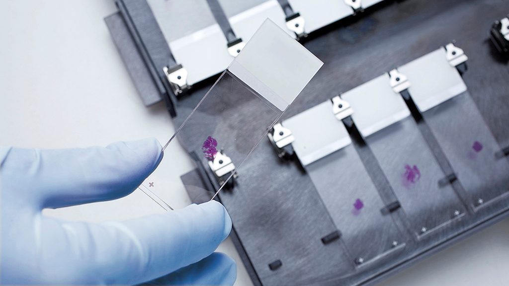 Photo of microscope slides with blood samples showing minimal residual disease (MRD)