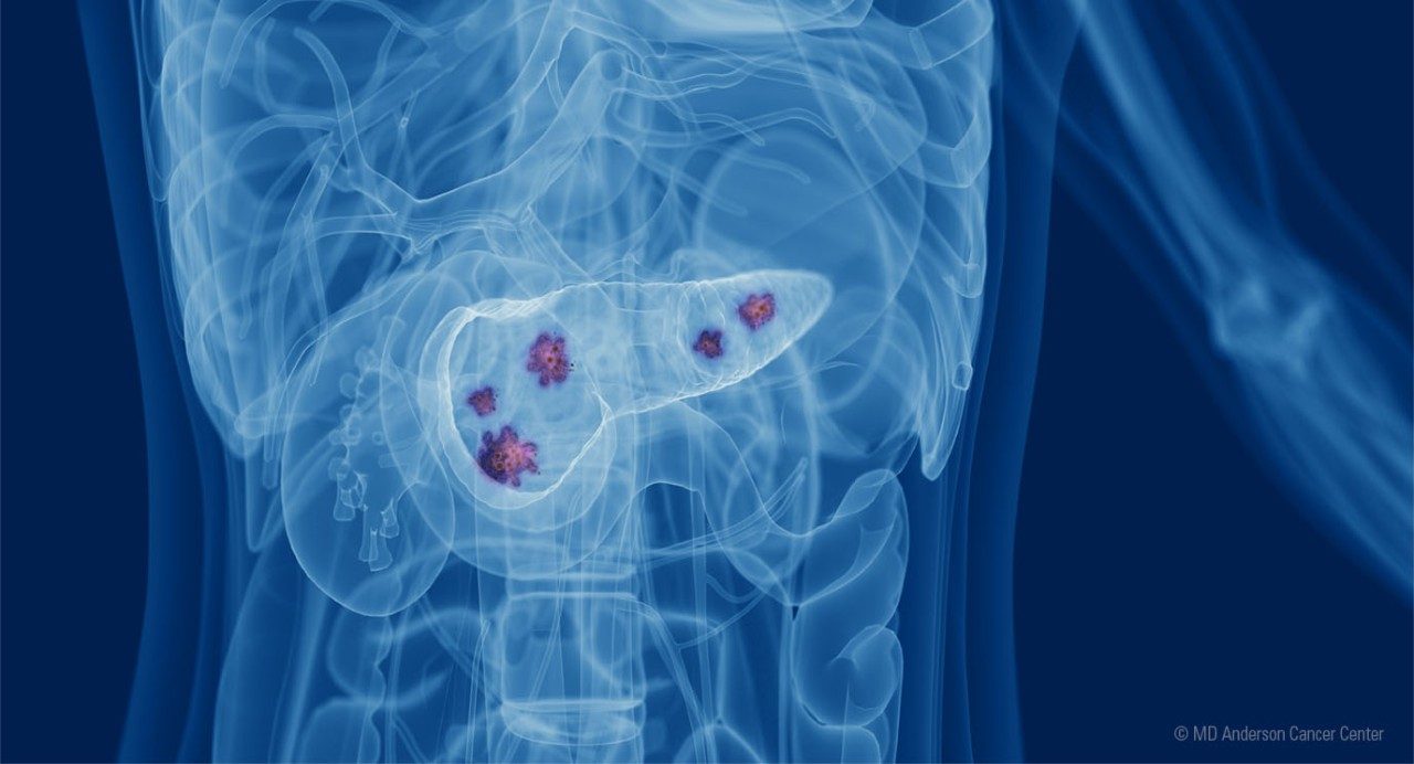X-Ray-like illustration of pancreas with cancerous lesions