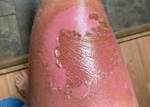 Logan Carver's leg peels as it heals from phytophotodermatitis. Painful blisters persisted for nearly 2 weeks before the damaged skin began to fall off.