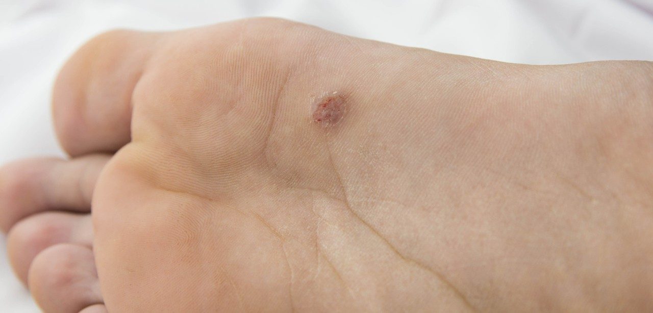 Close-up view of pencil-eraser-sized lesion a few inches below big toe on sole of foot