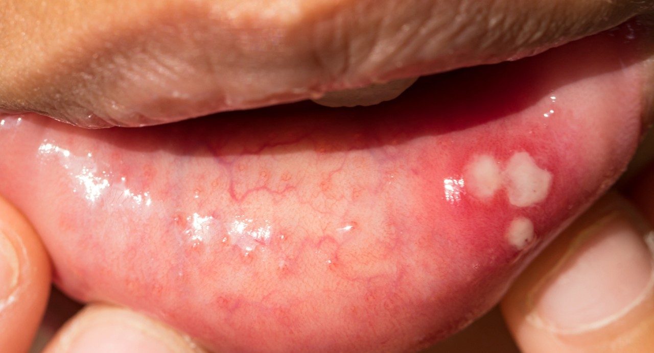 Close-up photo of three white canker sores/aphthous ulcers on pulled-down lower lip