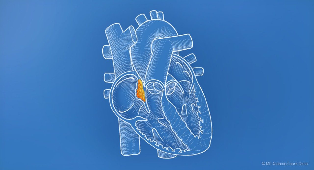 Illustration of the heart showing a tumor
