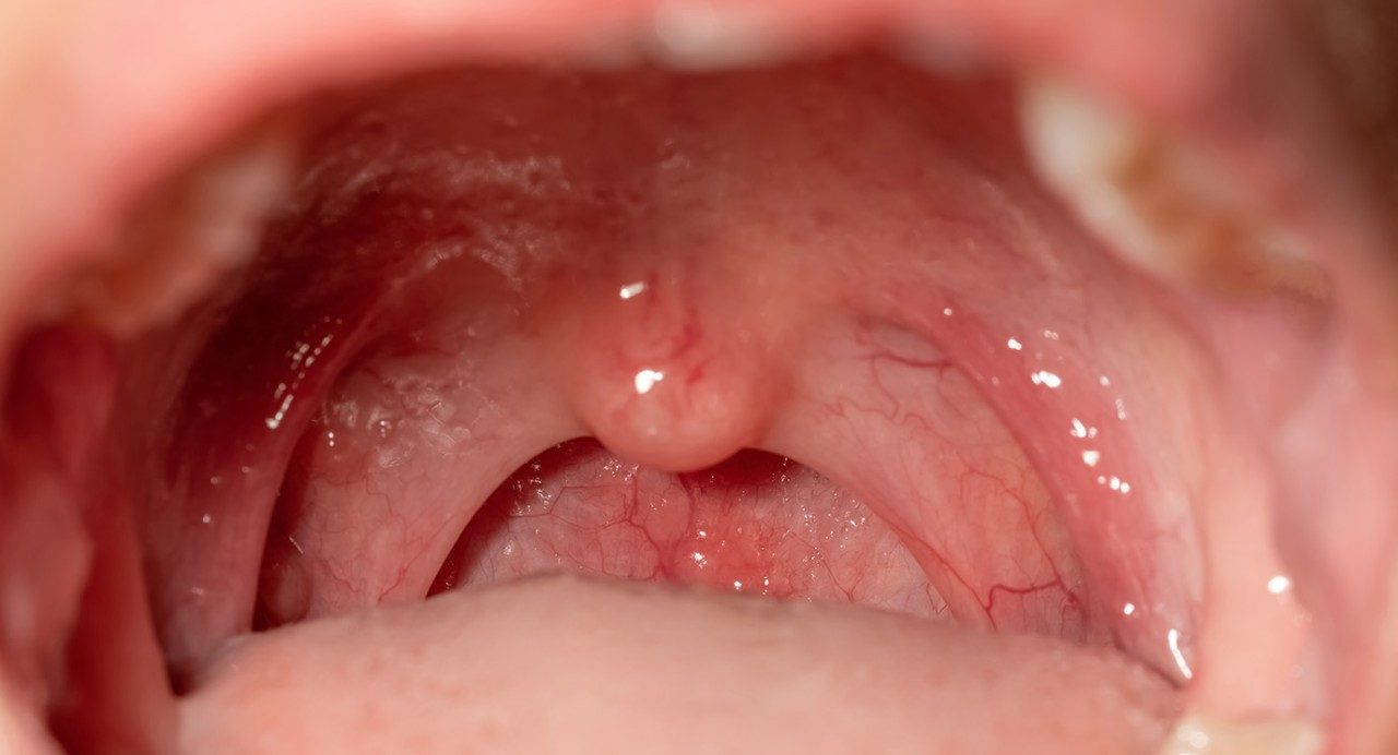 Close-up view of hard palate in open mouth, with uvula and throat visible