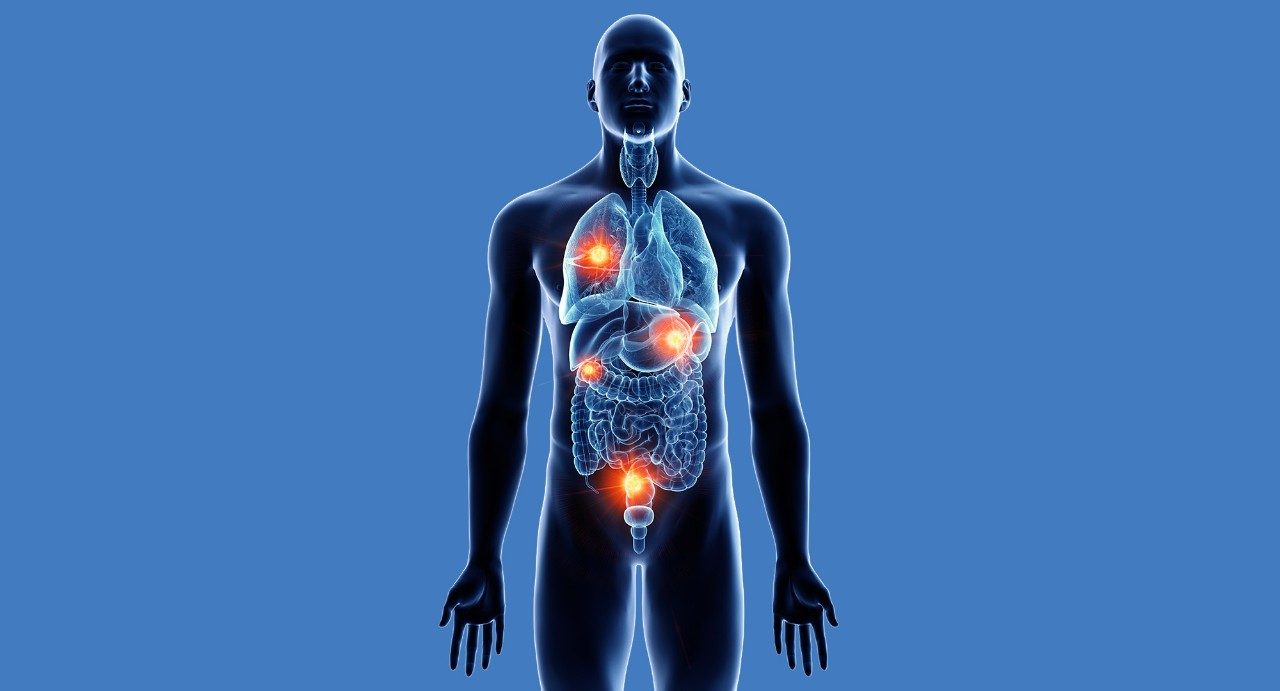 Medical illustration of a human skeleton with multiple tumors.