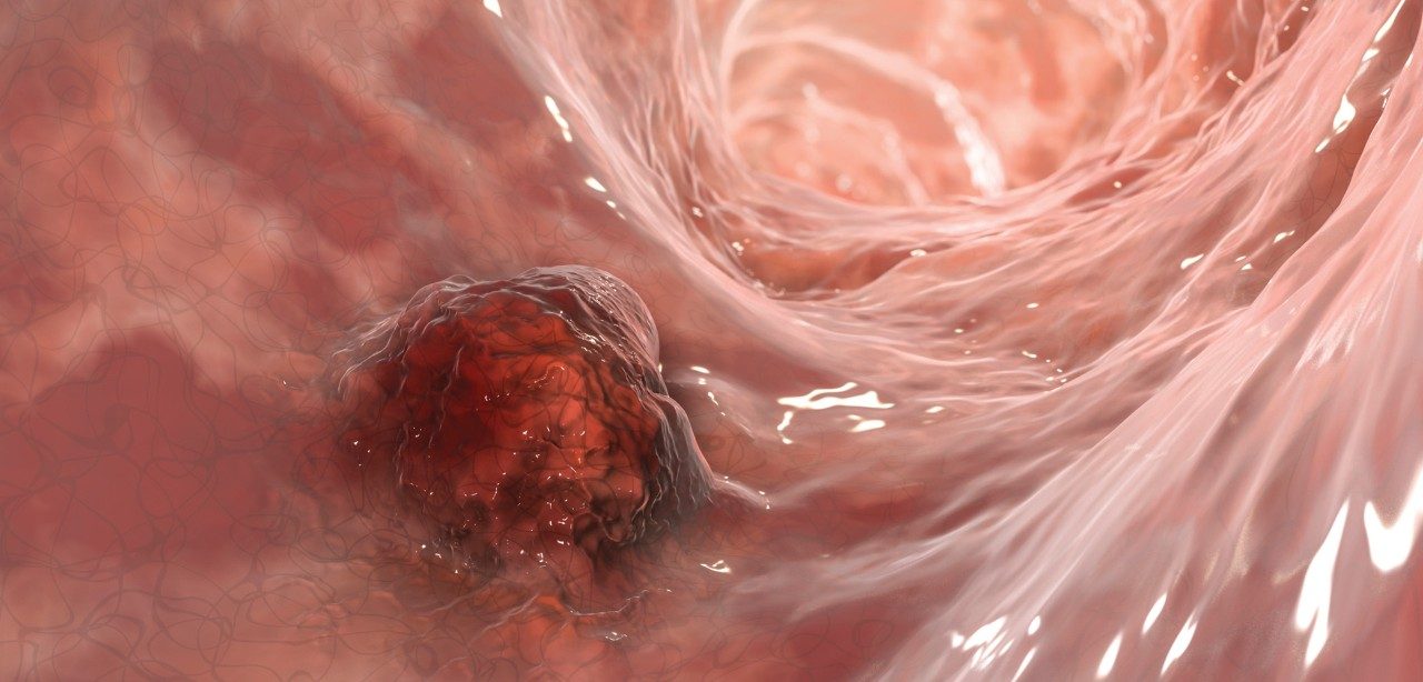 Medical illustration of an abnormal growth in a colon wall