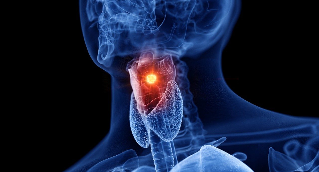 Computer illustration of larynx cancer