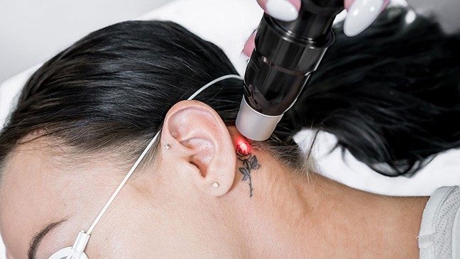 Woman wearing protective eyewear receiving laser tattoo removal on a rose tattoo behind her ear
