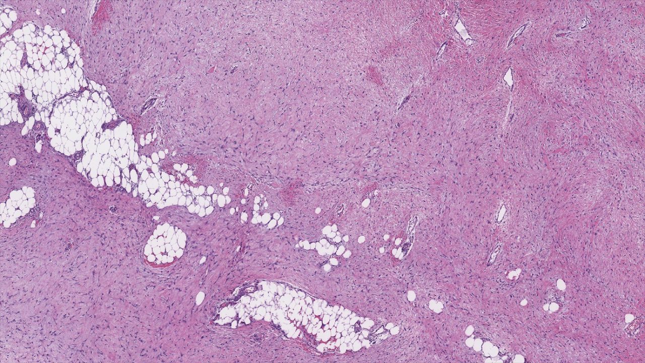 A look at demoid tumor tissue under a microscope