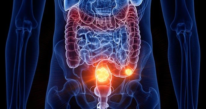 Cancer depicted in the sigmoid colon