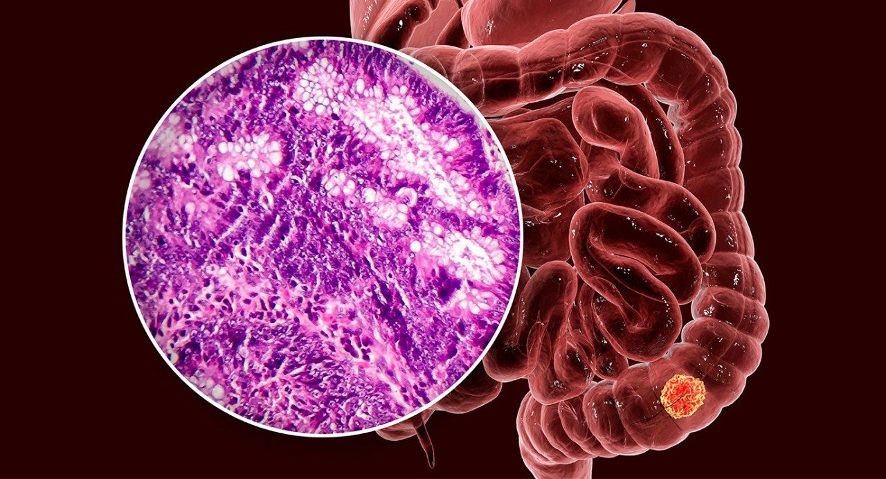Colon cancer with a closeup of a tumor