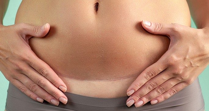Close-up of fit white woman's belly with well-healed horizontal scar across pubic area