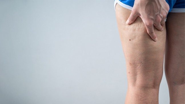 Woman touches the back of her upper leg