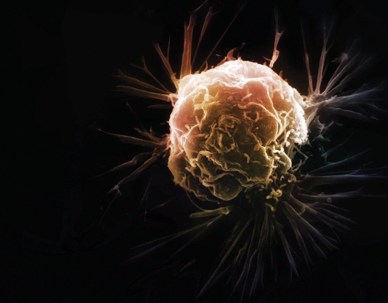 brain tumor