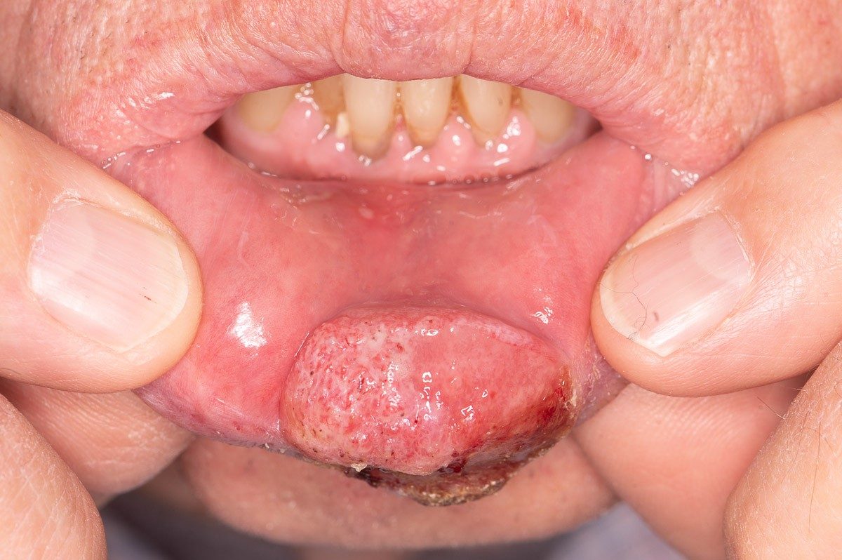 Cancer of the lower lip, a swollen area with a distinct border. 