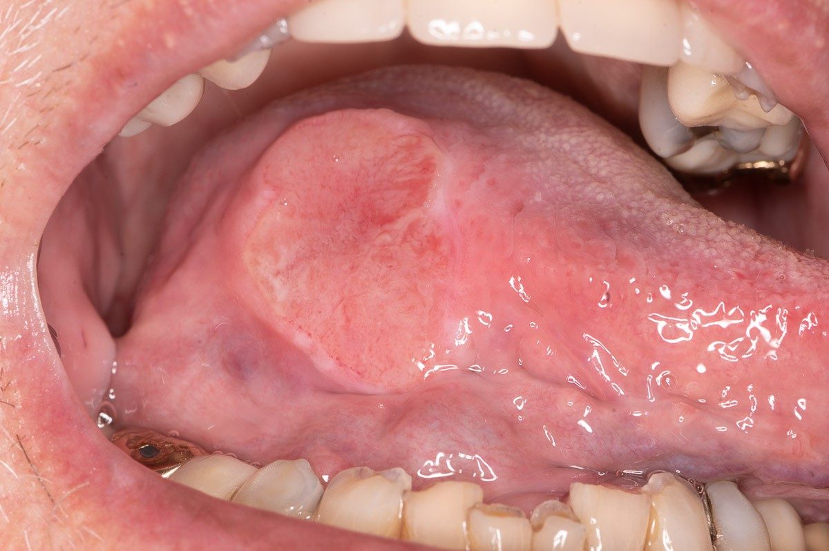 A cancer of the tongue, with a swollen area with a distinct border.
