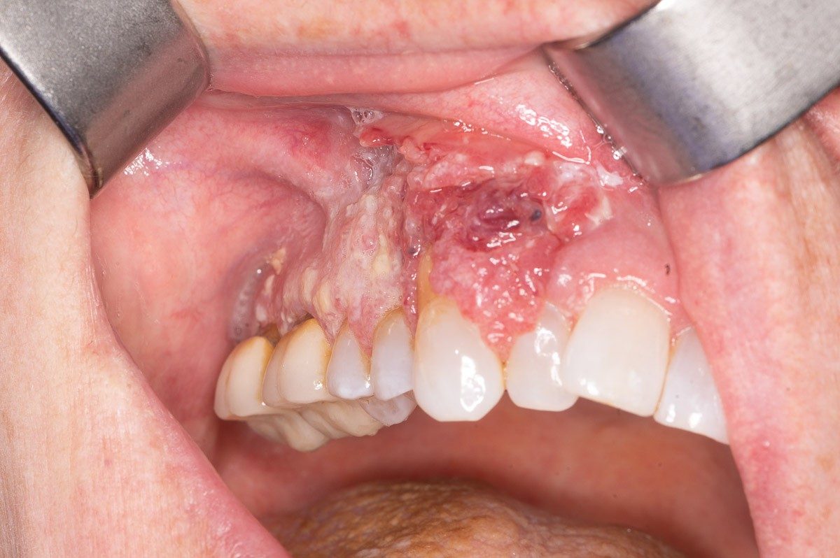 A cancer of the upper gingiva, or gum. The image shows a area with red sores and white patches.