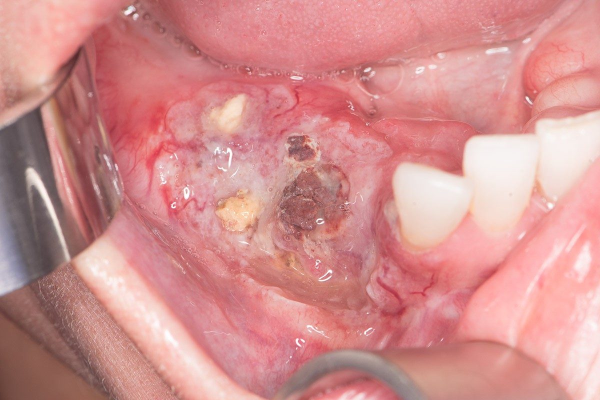 Cancer of the lower gums, behind the front teeth.The image shows a area with red sores and white patches.