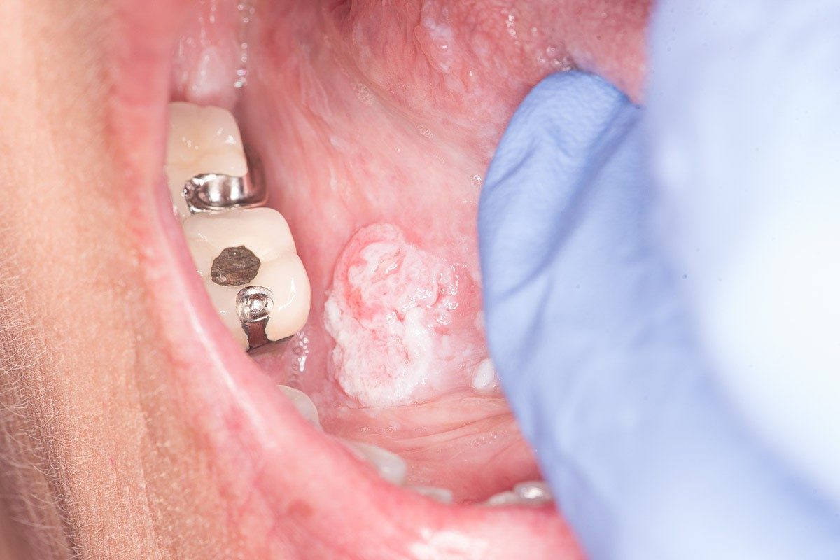 A cancerous lesion on the floor of the mouth, under the tongue. The image shows a swollen white patch with distinct borders.