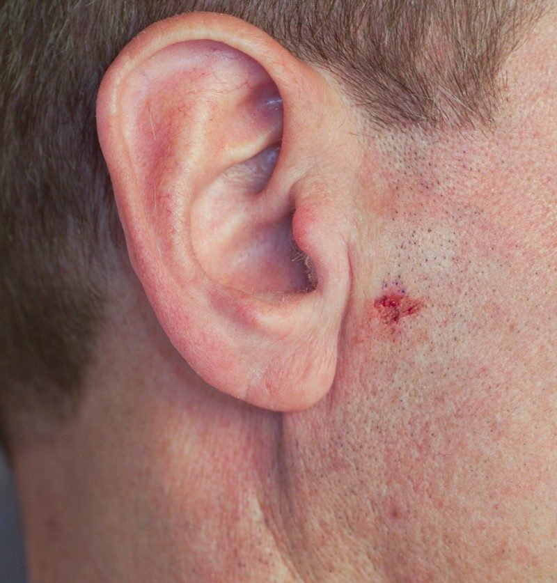 A nodular basal cell carcinoma near the patient's ear. This ulcerated growth looks like a cut, but it will not heal on its own.