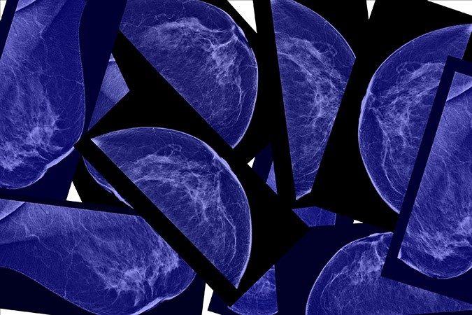 early-stage breast cancer
