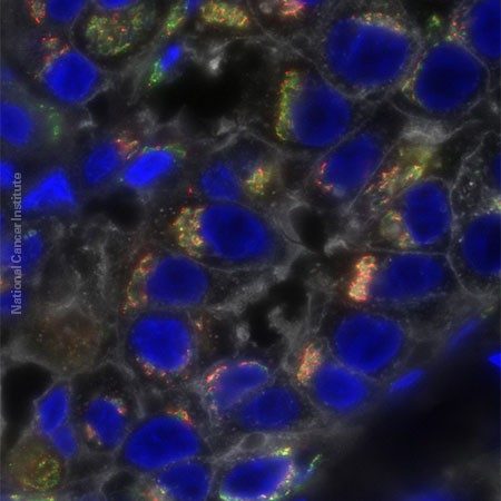 triple-negative breast cancer