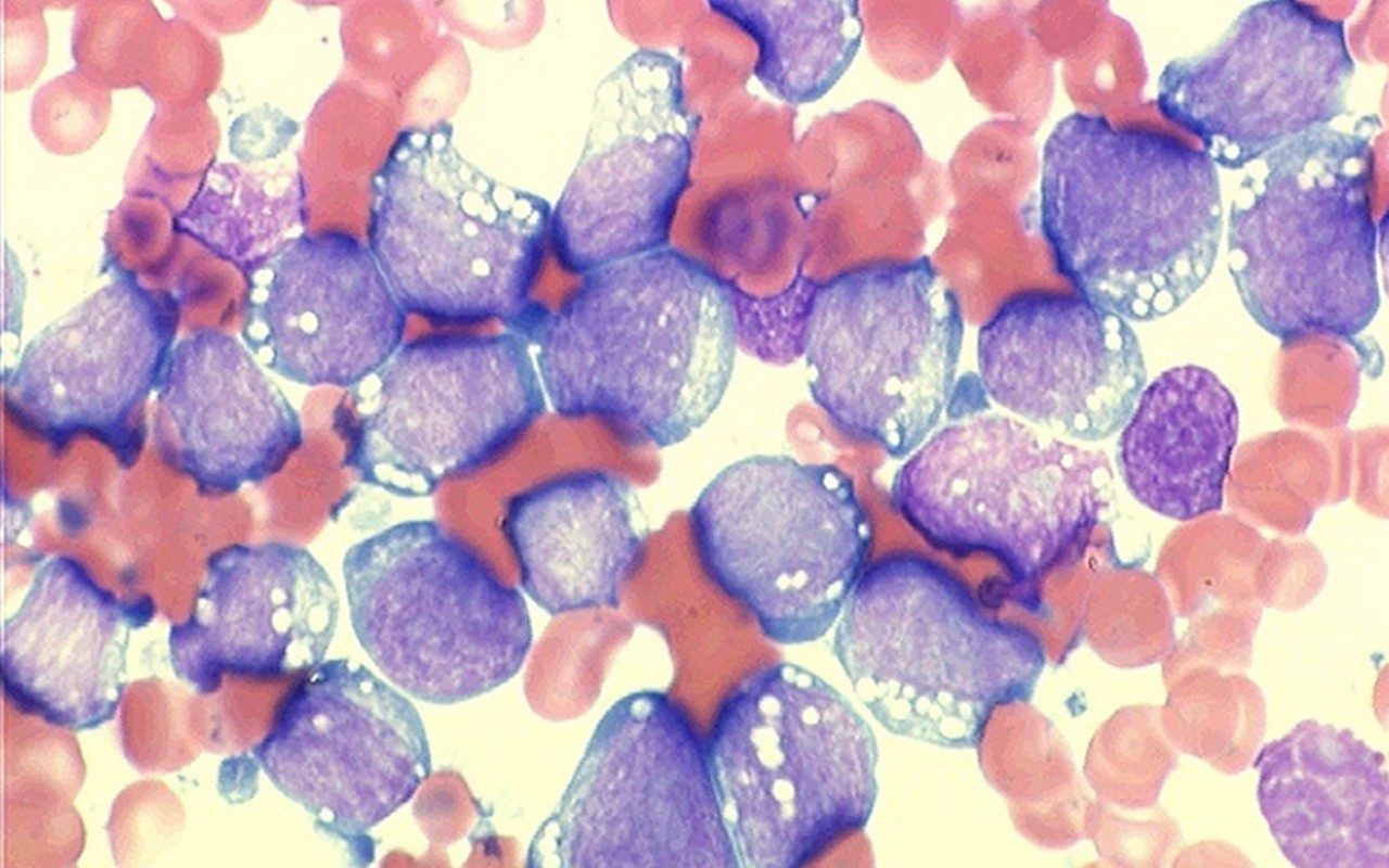 acute lymphoblastic leukemia