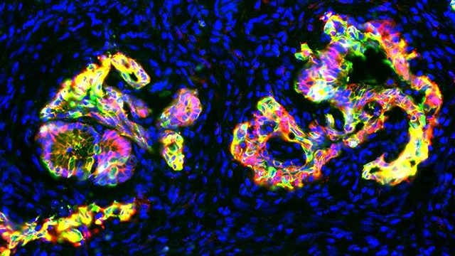 pancreatic ductal adenocarcinomas 