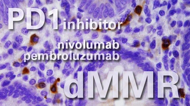 PD1 inhibitors help metastatic colorectal cancer patients