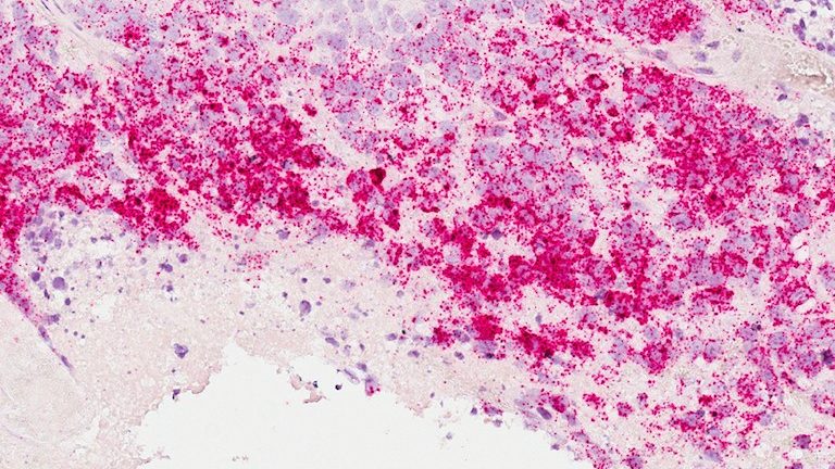 invasive breast cancer cells