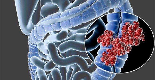 colorectal cancer