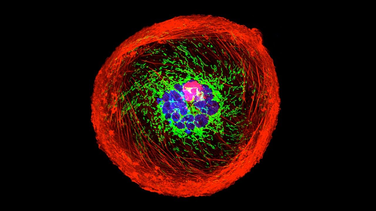 polyploid giant cancer cell (PGCC) from triple-negative breast cancer