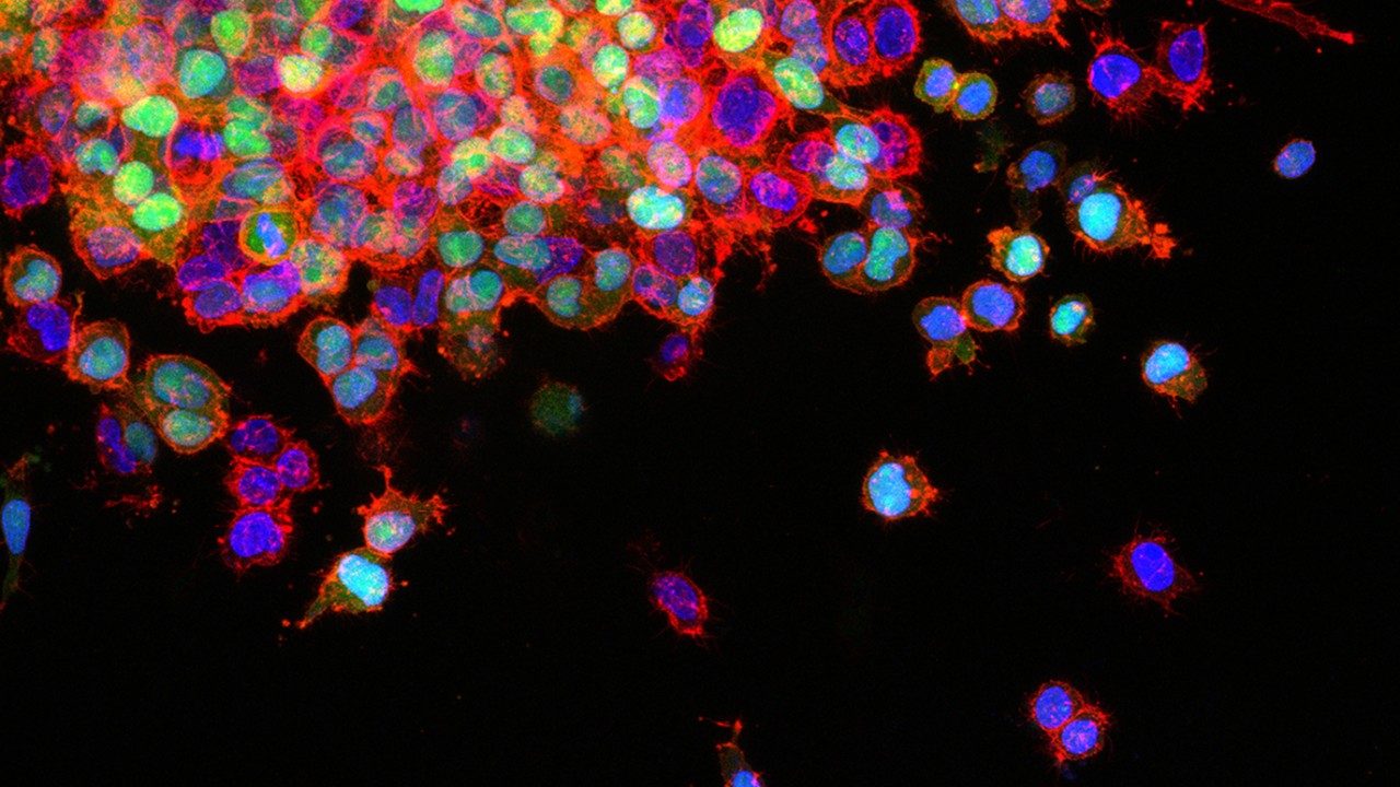 lung cancer metastasis