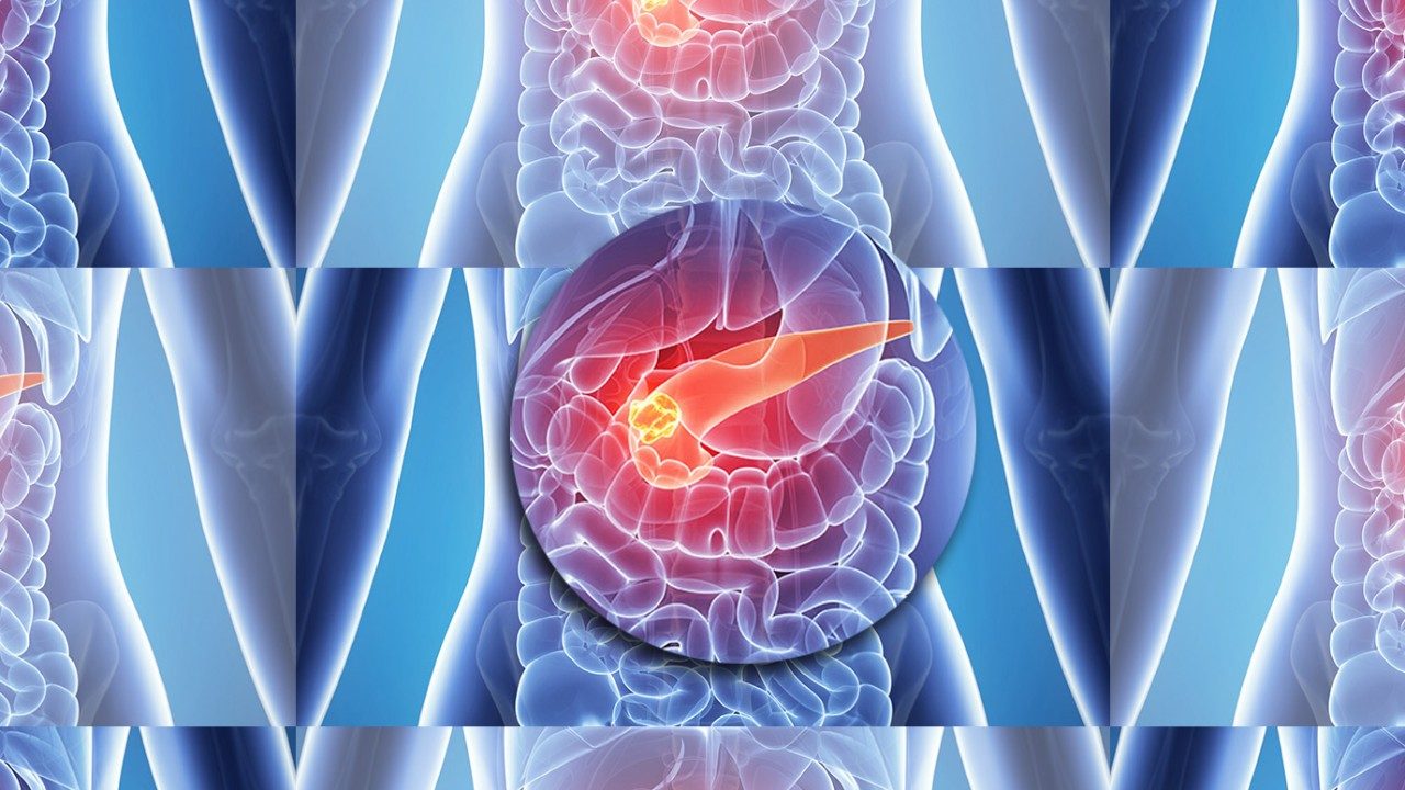 pancreatic cancer illustration
